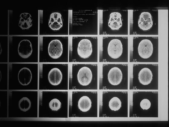 Brain scan